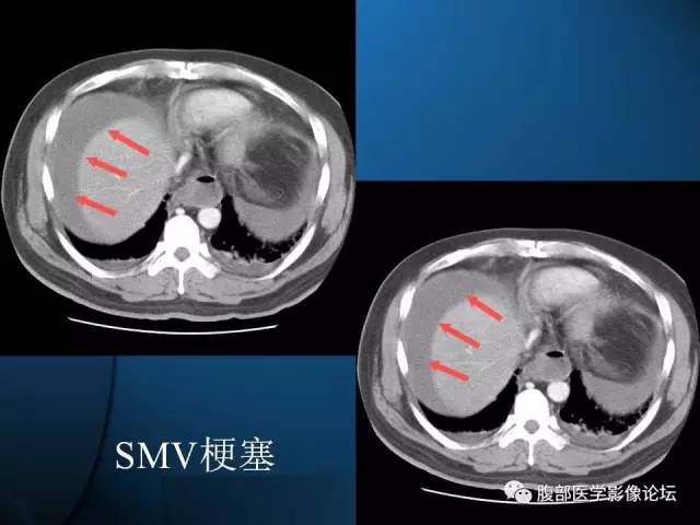 【PPT】 急腹症时的腹腔积气与积液