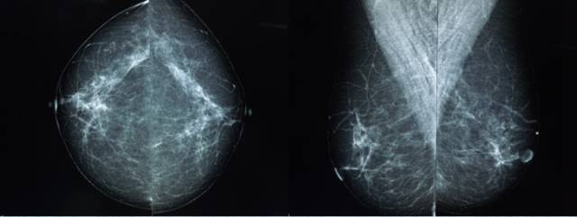 乳腺钼靶报告相关规范