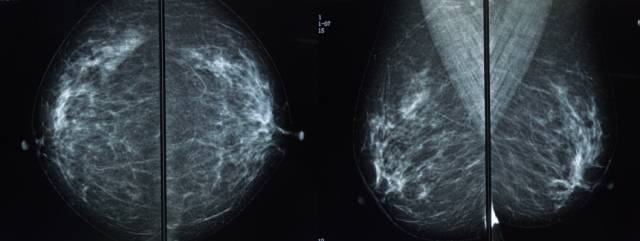 乳腺钼靶报告相关规范 乳腺钼靶报告相关规范