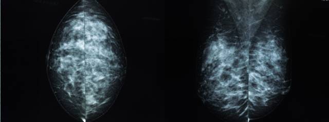 乳腺钼靶报告相关规范 乳腺钼靶报告相关规范