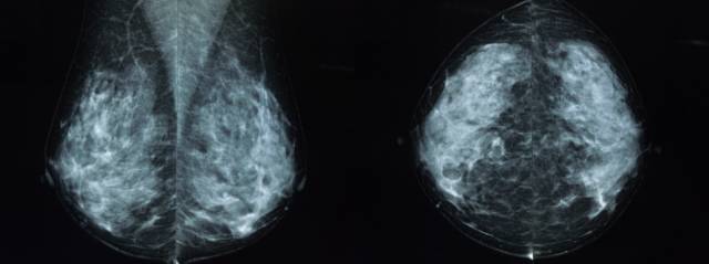 乳腺钼靶报告相关规范 乳腺钼靶报告相关规范