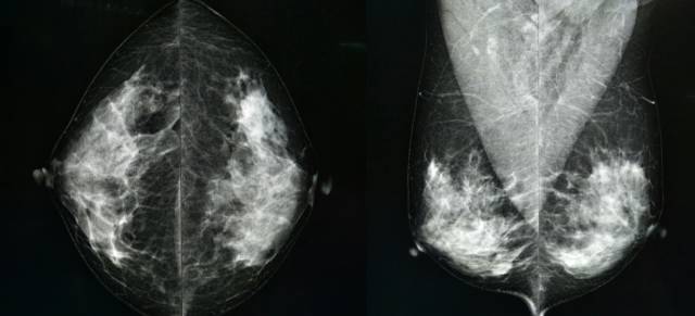 乳腺钼靶报告相关规范 乳腺钼靶报告相关规范