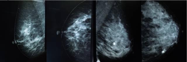 乳腺钼靶报告相关规范 乳腺钼靶报告相关规范