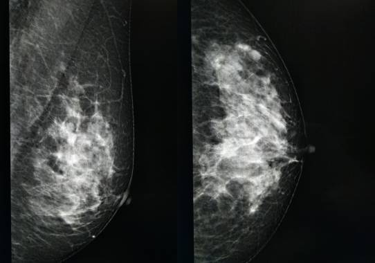 乳腺钼靶报告相关规范 乳腺钼靶报告相关规范
