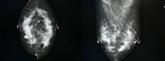 乳腺钼靶报告相关规范 乳腺钼靶报告相关规范