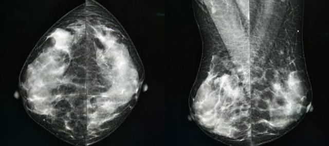 乳腺钼靶报告相关规范 乳腺钼靶报告相关规范