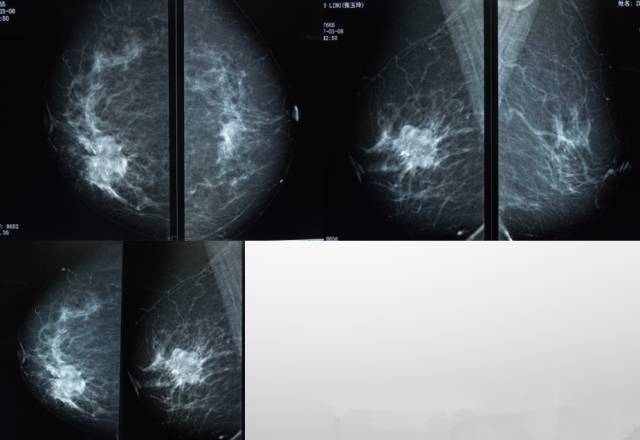 乳腺钼靶报告相关规范 乳腺钼靶报告相关规范