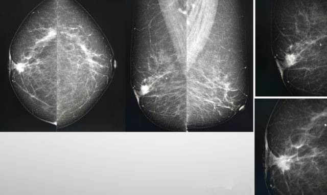 乳腺钼靶报告相关规范 乳腺钼靶报告相关规范