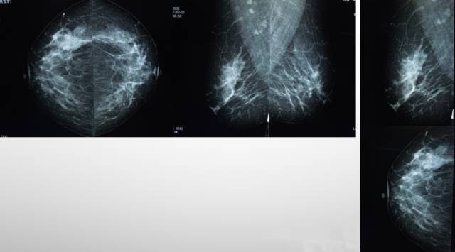 乳腺钼靶报告相关规范 乳腺钼靶报告相关规范