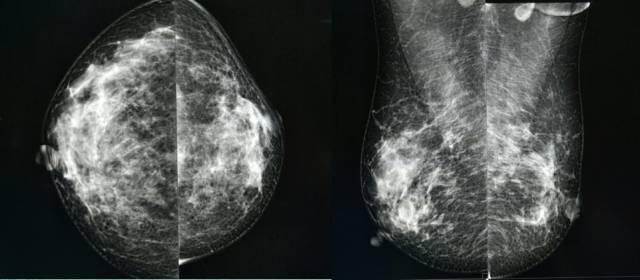 乳腺钼靶报告相关规范