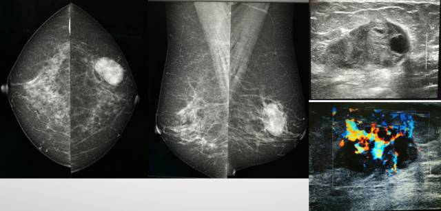 乳腺钼靶报告相关规范 乳腺钼靶报告相关规范