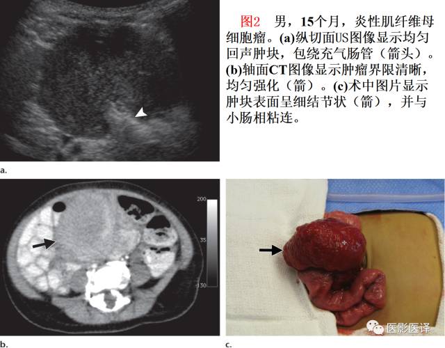 儿童腹膜、网膜及肠系膜实性肿瘤的影像与病理对照 儿童腹膜、网膜及肠系膜实性肿瘤的影像与病理对照