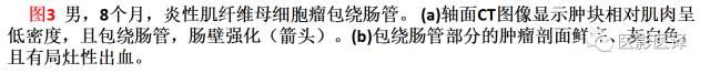 儿童腹膜、网膜及肠系膜实性肿瘤的影像与病理对照 儿童腹膜、网膜及肠系膜实性肿瘤的影像与病理对照