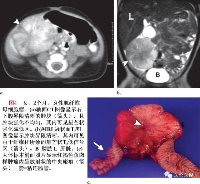 儿童腹膜、网膜及肠系膜实性肿瘤的影像与病理对照 儿童腹膜、网膜及肠系膜实性肿瘤的影像与病理对照