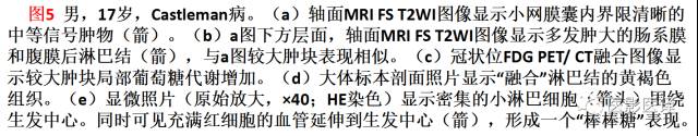 儿童腹膜、网膜及肠系膜实性肿瘤的影像与病理对照 儿童腹膜、网膜及肠系膜实性肿瘤的影像与病理对照