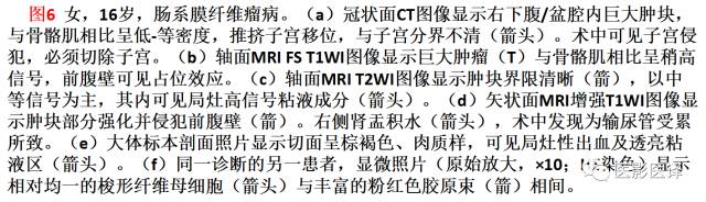 儿童腹膜、网膜及肠系膜实性肿瘤的影像与病理对照 儿童腹膜、网膜及肠系膜实性肿瘤的影像与病理对照