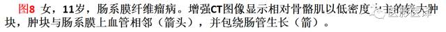 儿童腹膜、网膜及肠系膜实性肿瘤的影像与病理对照