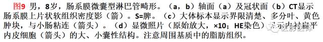 儿童腹膜、网膜及肠系膜实性肿瘤的影像与病理对照 儿童腹膜、网膜及肠系膜实性肿瘤的影像与病理对照