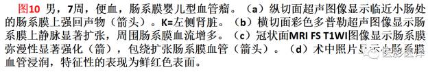 儿童腹膜、网膜及肠系膜实性肿瘤的影像与病理对照 儿童腹膜、网膜及肠系膜实性肿瘤的影像与病理对照