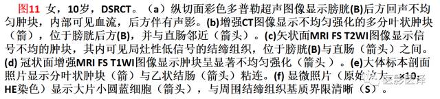 儿童腹膜、网膜及肠系膜实性肿瘤的影像与病理对照 儿童腹膜、网膜及肠系膜实性肿瘤的影像与病理对照