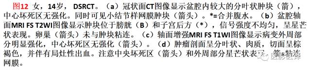 儿童腹膜、网膜及肠系膜实性肿瘤的影像与病理对照 儿童腹膜、网膜及肠系膜实性肿瘤的影像与病理对照