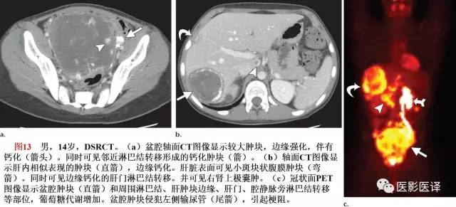 儿童腹膜、网膜及肠系膜实性肿瘤的影像与病理对照 儿童腹膜、网膜及肠系膜实性肿瘤的影像与病理对照