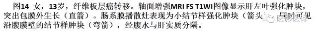 儿童腹膜、网膜及肠系膜实性肿瘤的影像与病理对照 儿童腹膜、网膜及肠系膜实性肿瘤的影像与病理对照