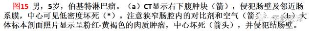 儿童腹膜、网膜及肠系膜实性肿瘤的影像与病理对照 儿童腹膜、网膜及肠系膜实性肿瘤的影像与病理对照