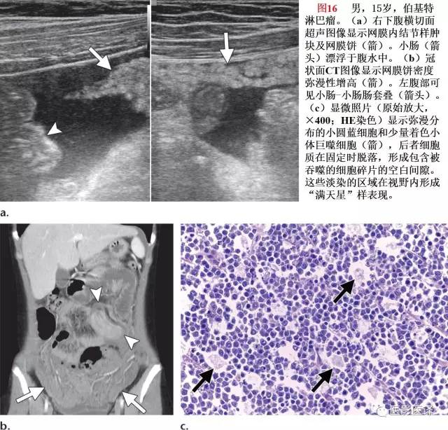 儿童腹膜、网膜及肠系膜实性肿瘤的影像与病理对照 儿童腹膜、网膜及肠系膜实性肿瘤的影像与病理对照
