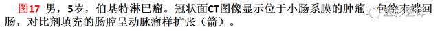 儿童腹膜、网膜及肠系膜实性肿瘤的影像与病理对照