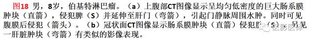 儿童腹膜、网膜及肠系膜实性肿瘤的影像与病理对照 儿童腹膜、网膜及肠系膜实性肿瘤的影像与病理对照