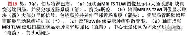 儿童腹膜、网膜及肠系膜实性肿瘤的影像与病理对照 儿童腹膜、网膜及肠系膜实性肿瘤的影像与病理对照