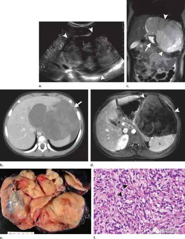 儿童腹膜、网膜及肠系膜实性肿瘤的影像与病理对照 儿童腹膜、网膜及肠系膜实性肿瘤的影像与病理对照