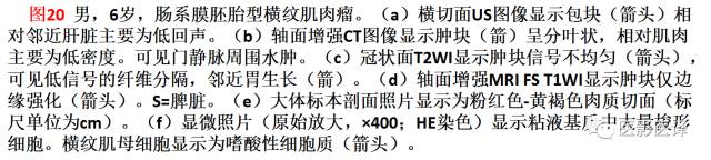 儿童腹膜、网膜及肠系膜实性肿瘤的影像与病理对照 儿童腹膜、网膜及肠系膜实性肿瘤的影像与病理对照