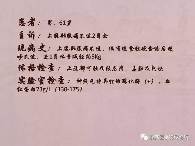 【病例】胃体神经内分泌癌1例CT 【病例】胃体神经内分泌癌1例CT