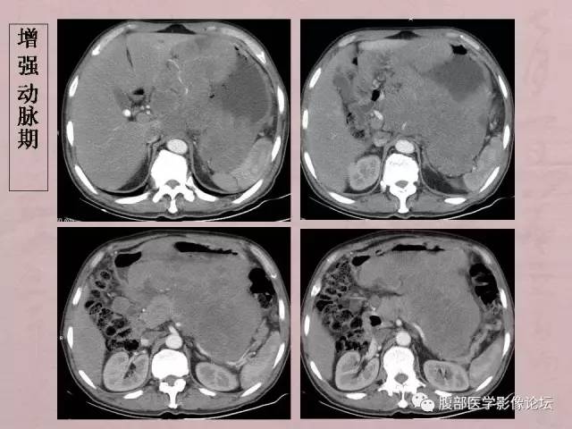 【病例】胃体神经内分泌癌1例CT 【病例】胃体神经内分泌癌1例CT