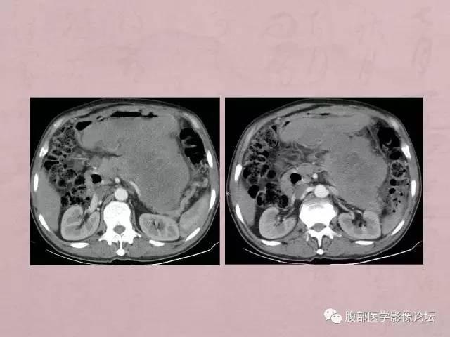 【病例】胃体神经内分泌癌1例CT 【病例】胃体神经内分泌癌1例CT