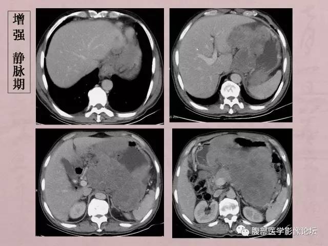 【病例】胃体神经内分泌癌1例CT