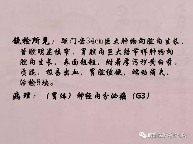 【病例】胃体神经内分泌癌1例CT 【病例】胃体神经内分泌癌1例CT