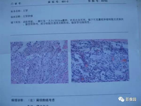 【病例】囊性肾癌1例CT影像表现