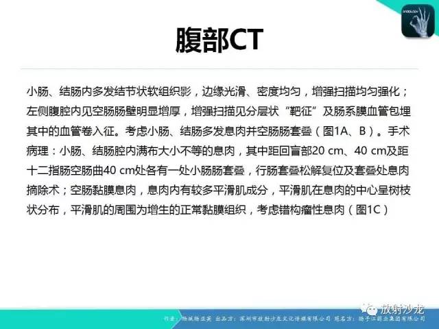 【病例】黑斑息肉病并肠套叠1例CT
