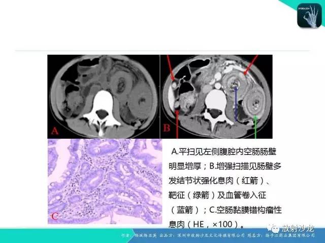 【病例】黑斑息肉病并肠套叠1例CT