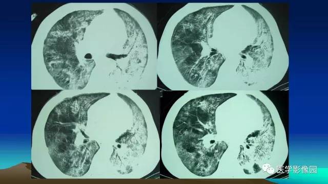 【病例】肺真菌病1例CT影像表现