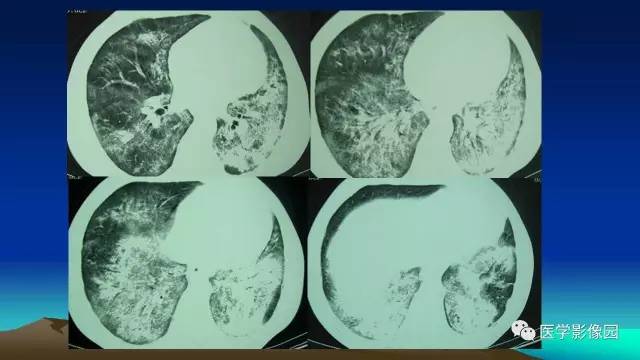 【病例】肺真菌病1例CT影像表现