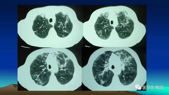 【病例】肺真菌病1例CT影像表现