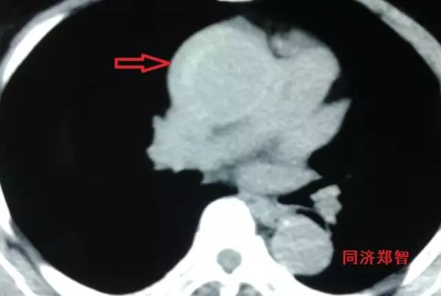 刷三观,主动脉夹层竟还有两个兄弟 刷三观,主动脉夹层竟还有两个兄弟