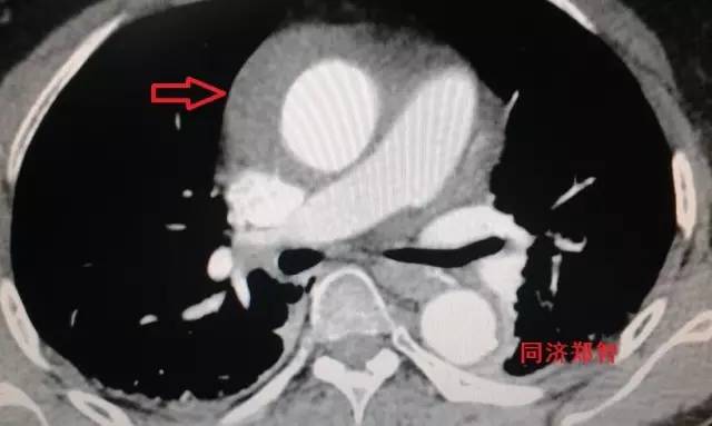 刷三观,主动脉夹层竟还有两个兄弟 刷三观,主动脉夹层竟还有两个兄弟