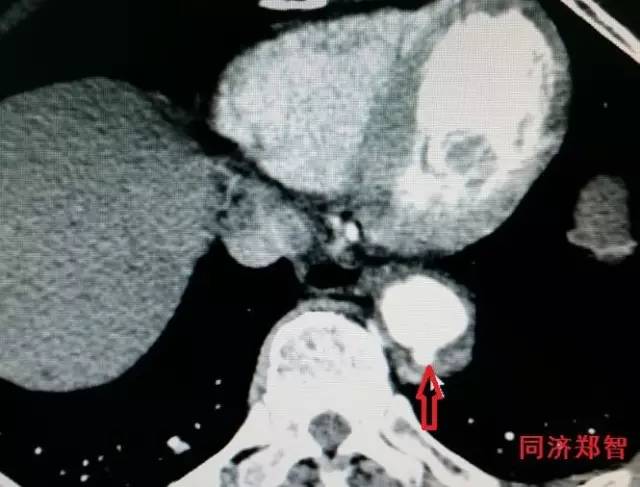刷三观,主动脉夹层竟还有两个兄弟 刷三观,主动脉夹层竟还有两个兄弟