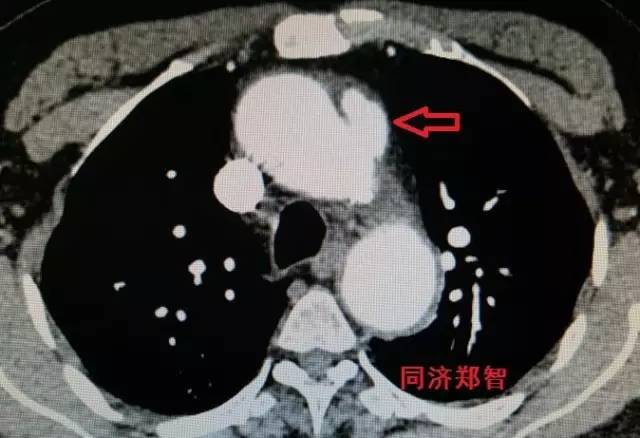 刷三观,主动脉夹层竟还有两个兄弟 刷三观,主动脉夹层竟还有两个兄弟