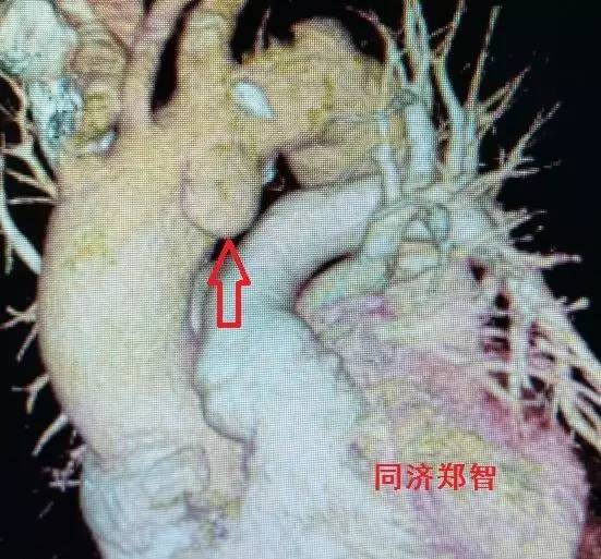 刷三观,主动脉夹层竟还有两个兄弟 刷三观,主动脉夹层竟还有两个兄弟